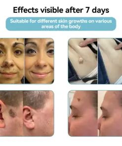 𝐉𝐚𝐬𝐬𝐞𝐞𝐦® 𝐍𝐨𝐧-𝐈𝐧𝐯𝐚𝐬𝐢𝐯𝐞 𝐌𝐨𝐥𝐞 & 𝐖𝐚𝐫𝐭 𝐋𝐚𝐬𝐞𝐫 𝐑𝐞𝐦𝐨𝐯𝐚𝐥 𝐏𝐞𝐧