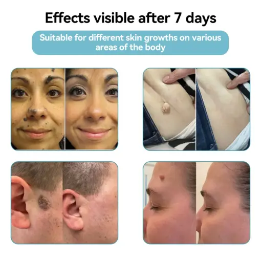 𝐉𝐚𝐬𝐬𝐞𝐞𝐦® 𝐍𝐨𝐧-𝐈𝐧𝐯𝐚𝐬𝐢𝐯𝐞 𝐌𝐨𝐥𝐞 & 𝐖𝐚𝐫𝐭 𝐋𝐚𝐬𝐞𝐫 𝐑𝐞𝐦𝐨𝐯𝐚𝐥 𝐏𝐞𝐧