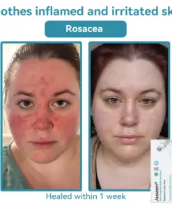 𝐉𝐚𝐬𝐬𝐞𝐞𝐦® 𝐍𝐨𝐧-𝐈𝐧𝐯𝐚𝐬𝐢𝐯𝐞 𝐌𝐨𝐥𝐞 & 𝐖𝐚𝐫𝐭 𝐋𝐚𝐬𝐞𝐫 𝐑𝐞𝐦𝐨𝐯𝐚𝐥 𝐏𝐞𝐧