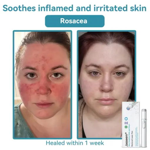 𝐉𝐚𝐬𝐬𝐞𝐞𝐦® 𝐍𝐨𝐧-𝐈𝐧𝐯𝐚𝐬𝐢𝐯𝐞 𝐌𝐨𝐥𝐞 & 𝐖𝐚𝐫𝐭 𝐋𝐚𝐬𝐞𝐫 𝐑𝐞𝐦𝐨𝐯𝐚𝐥 𝐏𝐞𝐧