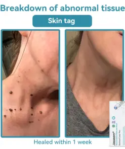 𝐉𝐚𝐬𝐬𝐞𝐞𝐦® 𝐍𝐨𝐧-𝐈𝐧𝐯𝐚𝐬𝐢𝐯𝐞 𝐌𝐨𝐥𝐞 & 𝐖𝐚𝐫𝐭 𝐋𝐚𝐬𝐞𝐫 𝐑𝐞𝐦𝐨𝐯𝐚𝐥 𝐏𝐞𝐧