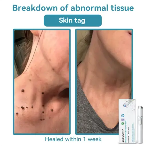 𝐉𝐚𝐬𝐬𝐞𝐞𝐦® 𝐍𝐨𝐧-𝐈𝐧𝐯𝐚𝐬𝐢𝐯𝐞 𝐌𝐨𝐥𝐞 & 𝐖𝐚𝐫𝐭 𝐋𝐚𝐬𝐞𝐫 𝐑𝐞𝐦𝐨𝐯𝐚𝐥 𝐏𝐞𝐧