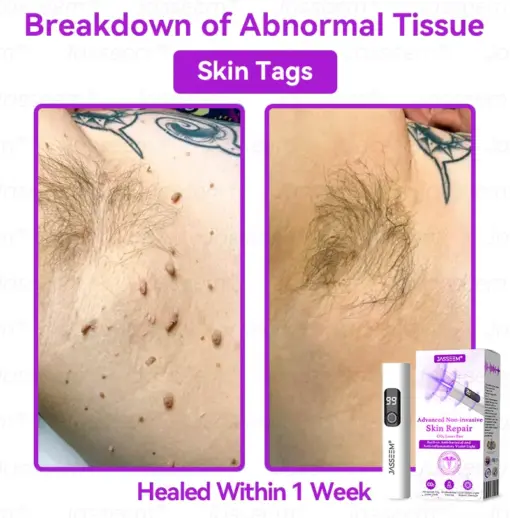 𝐉𝐚𝐬𝐬𝐞𝐞𝐦® Advanced Non-Invasive Skin Repair CO₂ Laser Pen