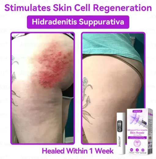 𝐉𝐚𝐬𝐬𝐞𝐞𝐦® Advanced Non-Invasive Skin Repair CO₂ Laser Pen