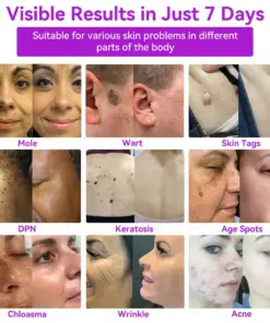 𝐉𝐚𝐬𝐬𝐞𝐞𝐦® Advanced Non-Invasive Skin Repair CO₂ Laser Pen