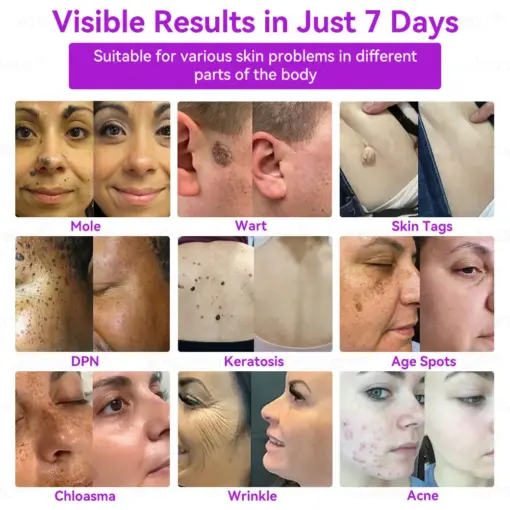 𝐉𝐚𝐬𝐬𝐞𝐞𝐦® Advanced Non-Invasive Skin Repair CO₂ Laser Pen