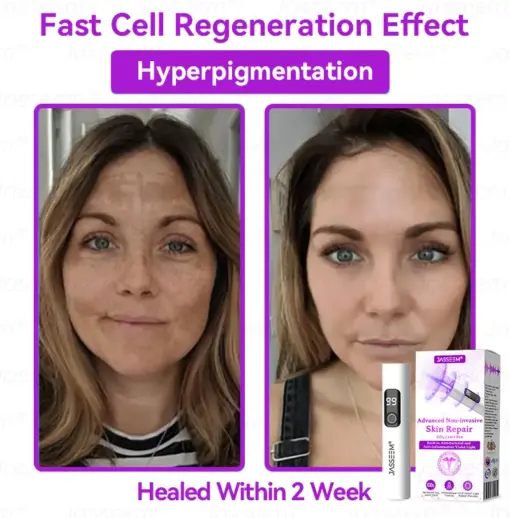 𝐉𝐚𝐬𝐬𝐞𝐞𝐦® Advanced Non-Invasive Skin Repair CO₂ Laser Pen