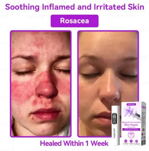 𝐉𝐚𝐬𝐬𝐞𝐞𝐦® Advanced Non-Invasive Skin Repair CO₂ Laser Pen