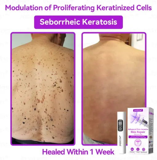 𝐉𝐚𝐬𝐬𝐞𝐞𝐦® Advanced Non-Invasive Skin Repair CO₂ Laser Pen