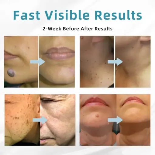 𝐉𝐚𝐬𝐬𝐞𝐞𝐦® Medical-Grade Laser Pen