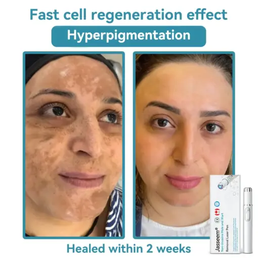 𝐉𝐚𝐬𝐬𝐞𝐞𝐦® Medical-Grade Laser Pen