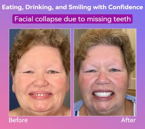 𝐉𝐚𝐬𝐬𝐞𝐞𝐦® Latest Premium Comfort Dentures