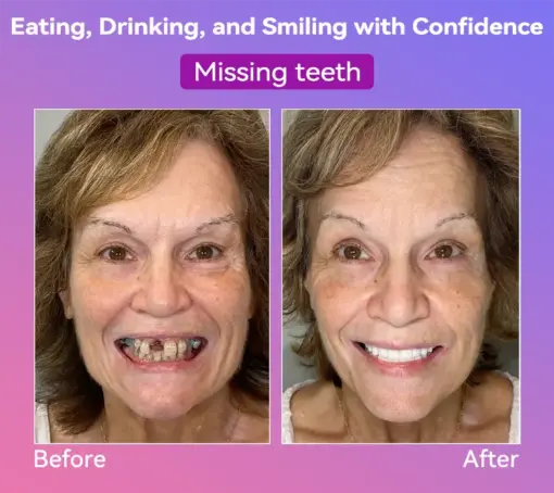 𝐉𝐚𝐬𝐬𝐞𝐞𝐦® Latest Premium Comfort Dentures