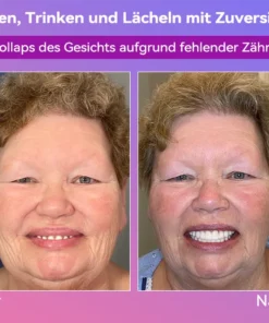 𝐉𝐚𝐬𝐬𝐞𝐞𝐦® Neueste Premium-Komfort-Zahnersätze