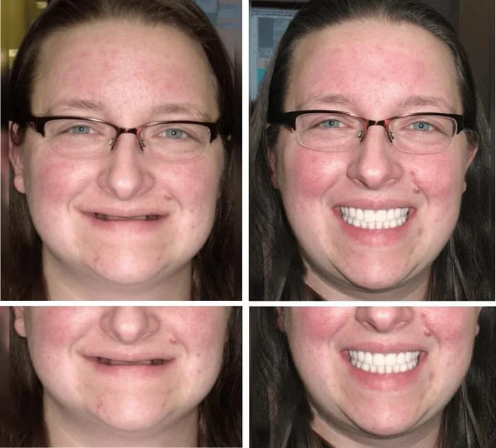 Custom-Fit Functional Denture - Image 4