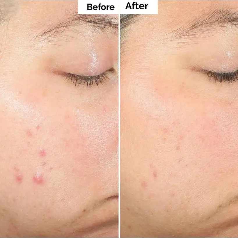 Pore & Spot Care Duo| Shrinks Pores & Fades Blemish Marks - Image 8