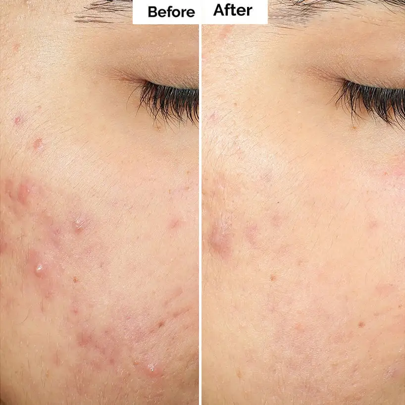 Pore & Spot Care Duo| Shrinks Pores & Fades Blemish Marks - Image 9