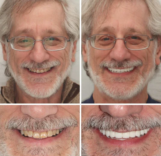 Custom-Fit Functional Denture - Image 3