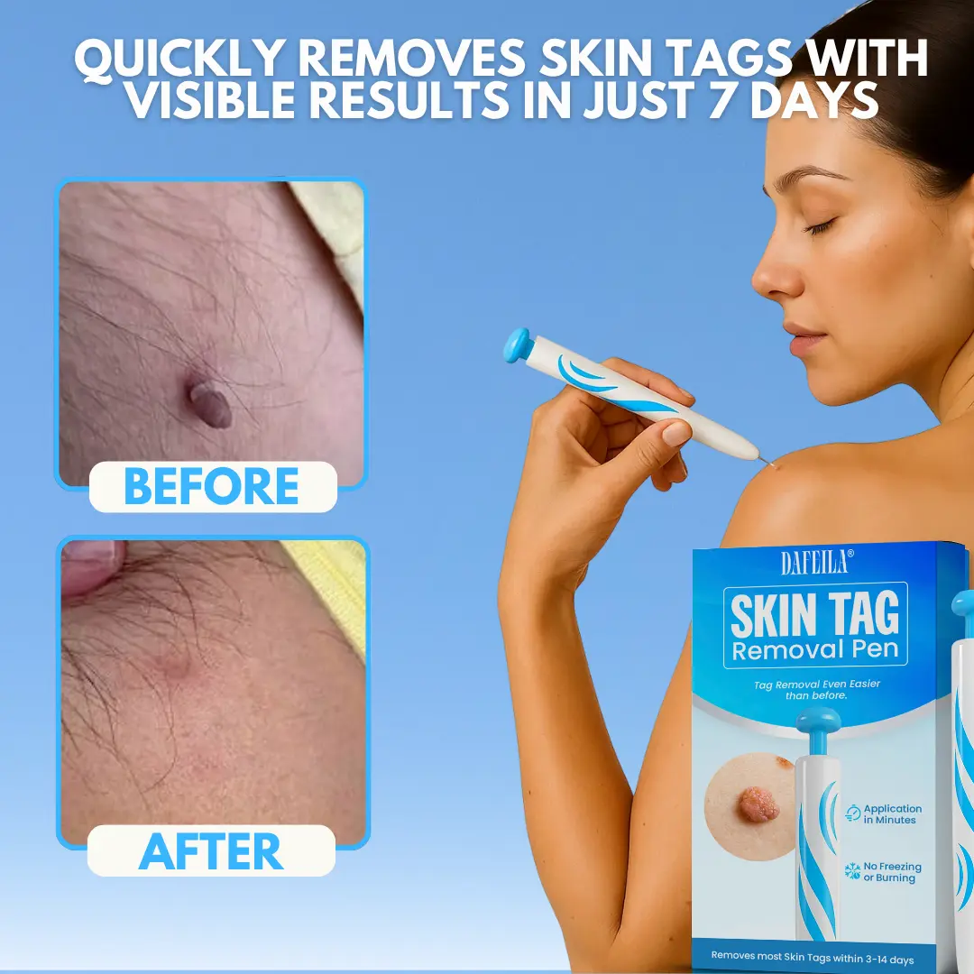 Skin Tag Removal Pen - Image 3
