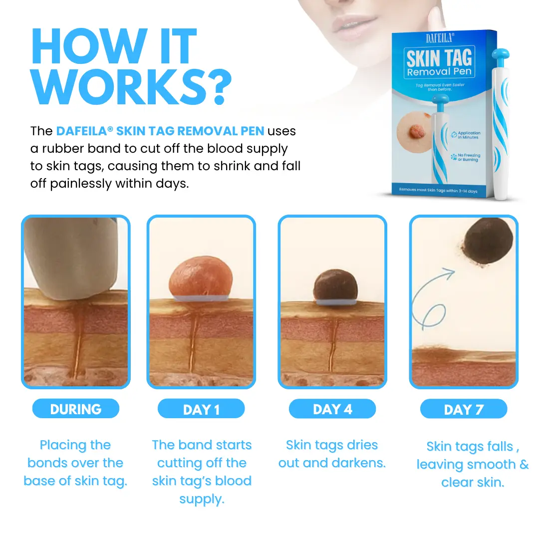 Skin Tag Removal Pen ACE - Image 4