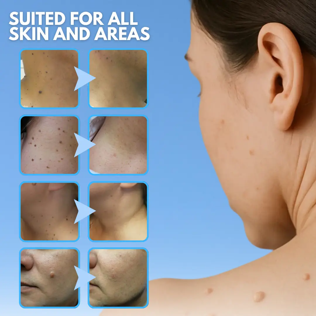 Skin Tag Removal Pen ACE - Image 5