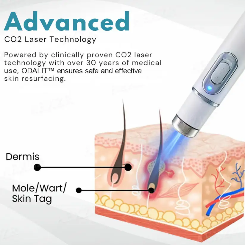 Non-Invasive Mole and Wart Removal Laser Pen - Image 7