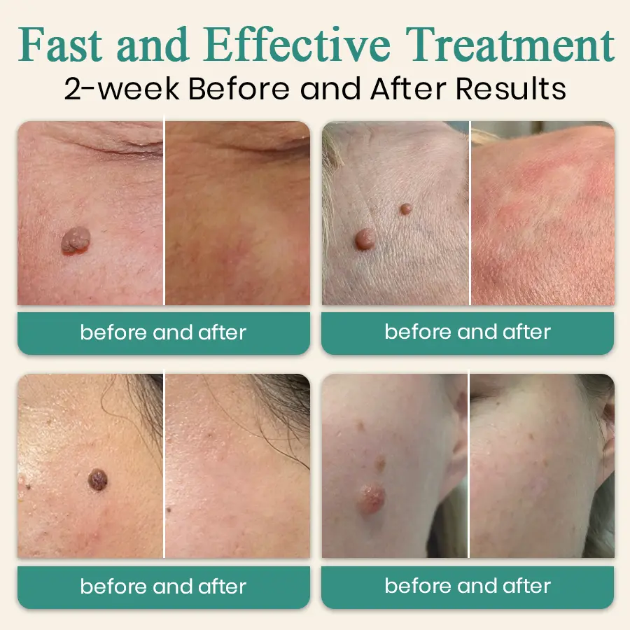 LumeSkin Mole and Wart Instant Removal Laser Pen ACE 5 - Image 2