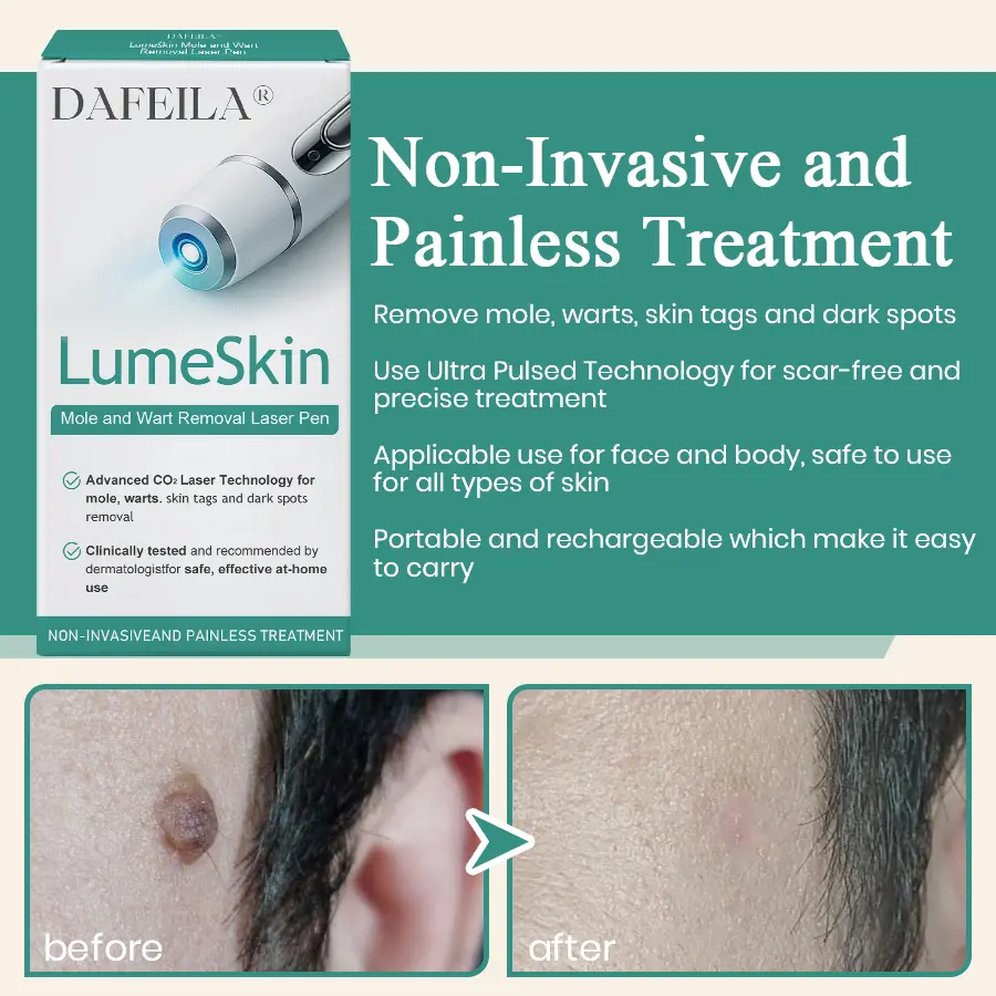 LumeSkin Mole and Wart Instant Removal Laser Pen ACE 5 - Image 4