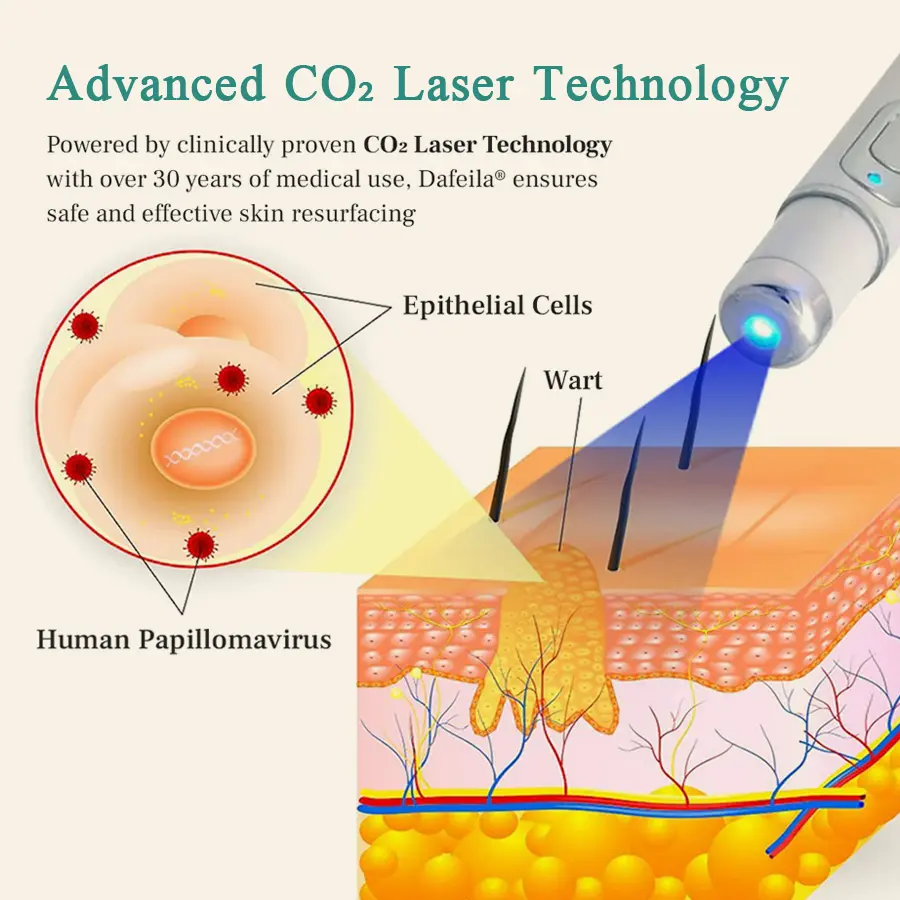 LumeSkin Mole and Wart Instant Removal Laser Pen ACE 5 - Image 5
