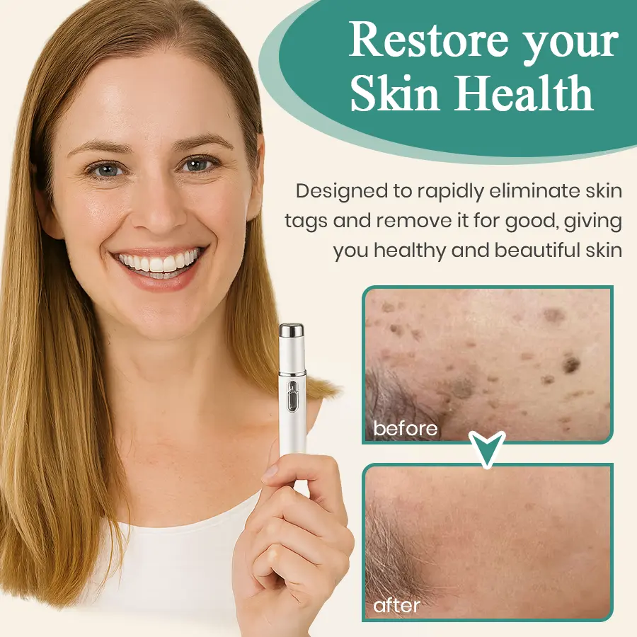 LumeSkin Mole and Wart Instant Removal Laser Pen ACE 5 - Image 6