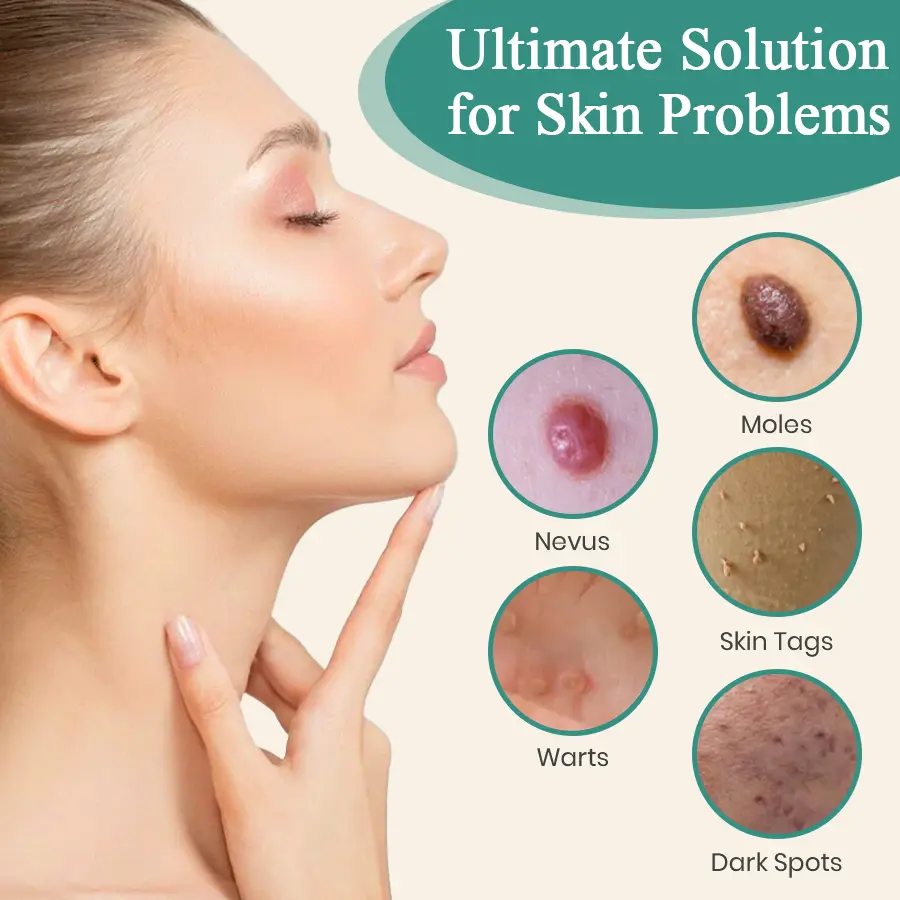 LumeSkin Mole and Wart Instant Removal Laser Pen ACE 5 - Image 8